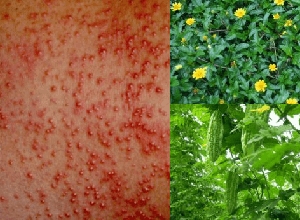 Mách bạn cách trị rôm sảy ở người lớn bằng bài thuốc dân gian hiệu quả ngay tại nhà